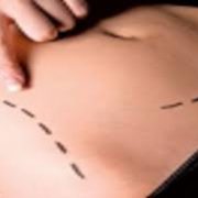 Cosmetic Abdominal Surgery 3