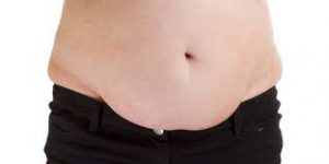 Abdominoplasty (Tummy Tuck)55