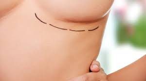 breast augmentation1