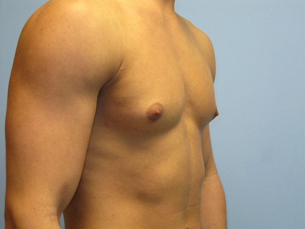 جراحی کوچک کردن سینه مردان در کرج - دکتر وفائی