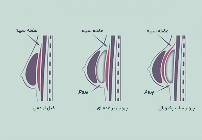 پروتز سینه