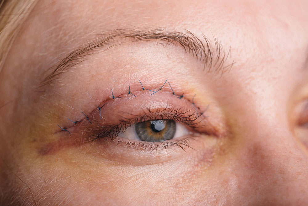 جراحی پلک و چشم - دکتر وفائی