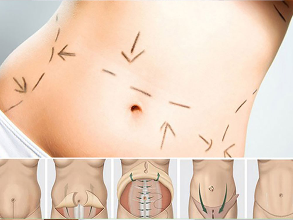 جراحی زیبایی و کشیدن پوست شکم - دکتر وفائی