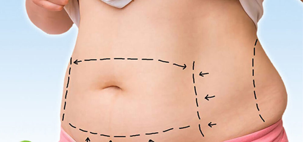 جراحی زیبایی و کشیدن پوست شکم - دکتر وفائی
